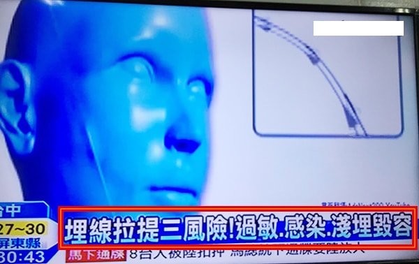 Quill8字,埋線拉提三風險!過敏感染埋線毀容