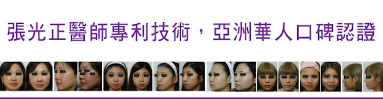 【全真自體系列-QUILL自體隆鼻(Q鼻)+強升鋼架】五官立體高顏值 決勝點靠高挺鼻+小巧尖下巴,張光正醫師專利技術,亞洲華人口碑認證