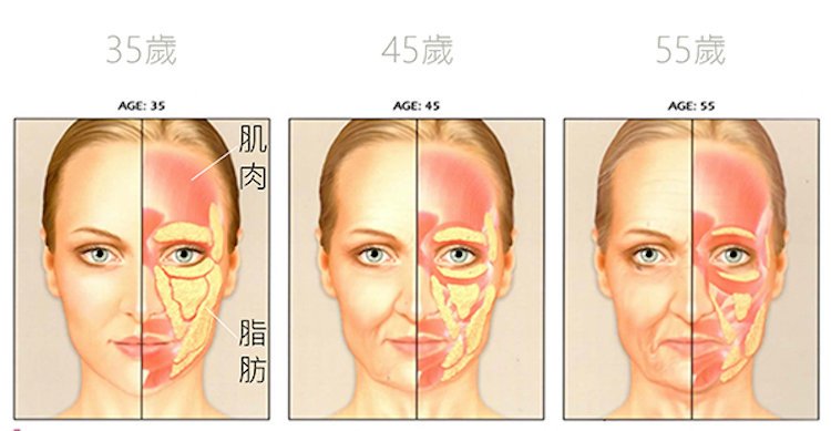 立新美學,三層次,拉皮【三層次緊顏拉皮】拉皮全新進化版 由深至淺全面拉提收緊 姐的年紀、妹的外表!三層次拉皮手術,改造前before,改造後AFTER
