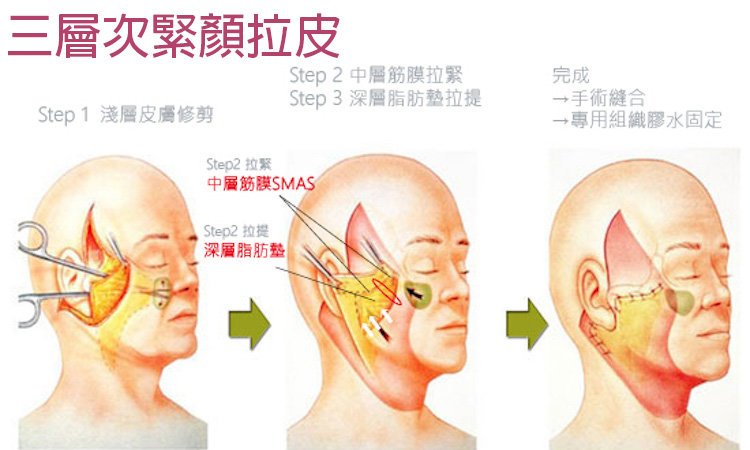 立新美學,三層次,拉皮,立新美學,三層次,拉皮,【三層次緊顏拉皮】拉皮全新進化版 由深至淺全面拉提收緊 姐的年紀、妹的外表!三層次拉皮手術,step1淺層皮膚修剪,step2中層筋膜拉緊,step3深層脂肪墊拉提,完成手術縫合,專用組織膠水固定,step2拉緊中層筋膜SMAS,STEP2拉提深層脂肪墊
