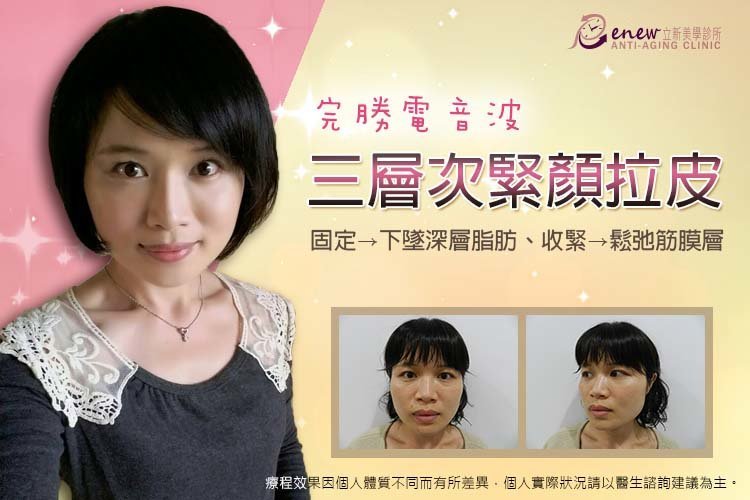【三層次緊顏拉皮】拉皮全新進化版 由深至淺全面拉提收緊 姐的年紀、妹的外表!完勝電音波,三層次緊顏拉皮,固定、下墜深層脂肪、收緊,鬆弛筋膜層