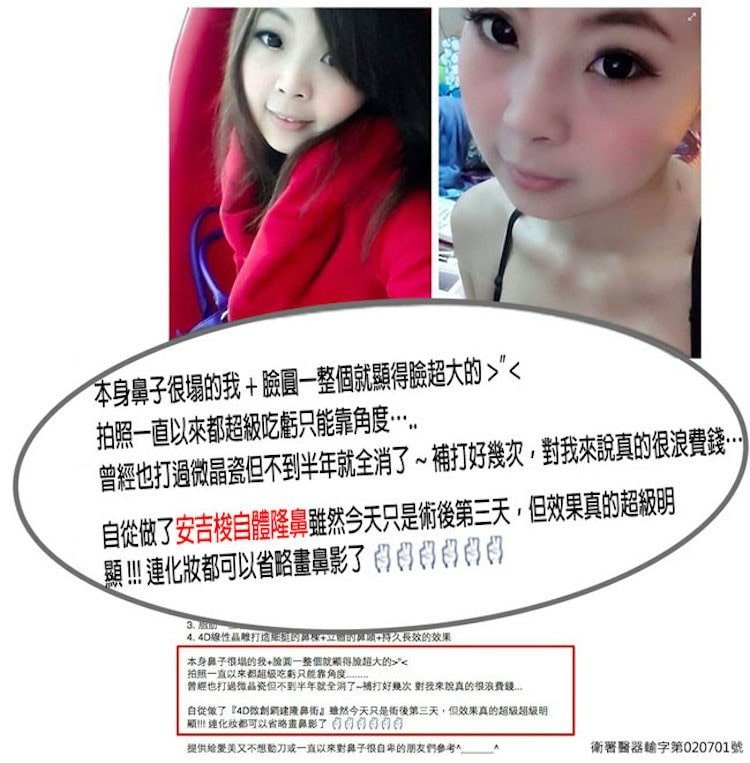 【全真自體系列-QUILL自體隆鼻(Q鼻)+強升鋼架】五官立體高顏值 決勝點靠高挺鼻+小巧尖下巴,本身鼻子很塌的我+臉圓一整個就顯得臉超大的,拍照一直以來都超級吃虧只能靠角度,曾經也打過微晶瓷但不到半年就全消了,補打好幾次,對我來說真的很浪費錢,自從做了安吉梭自體隆鼻雖然今天只是術後第三天,但效果真的超級明顯,連化妝都可以省略話鼻影了,