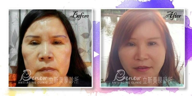 【三層次緊顏拉皮】拉皮全新進化版 由深至淺全面拉提收緊 姐的年紀、妹的外表!
