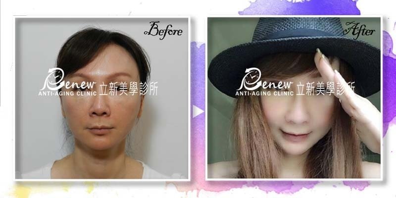 【三層次緊顏拉皮】拉皮全新進化版 由深至淺全面拉提收緊 姐的年紀、妹的外表!