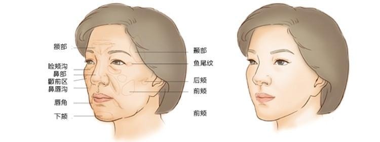 【自體脂肪移植補臉】智能型-自體脂肪全臉雕塑,額部,臉頰溝,鼻部,顴前區,鼻唇溝,唇角,下顎,魚尾紋,後頰,前頰