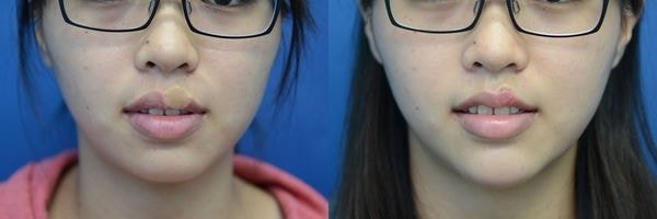【謝氏縮唇/3D俏唇珠】醜唇形怎麼辦? 謝氏縮唇終結它!,立新美學診所