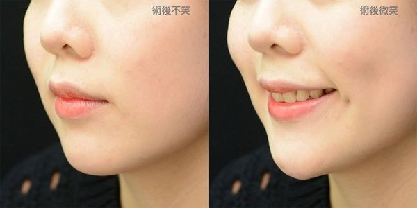 【加個梨窩,讓笑容更甜一點! 謝氏超自然梨渦手術!,立新美學診所,術後微笑,術後不笑
