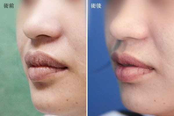 【加個梨窩,讓笑容更甜一點! 謝氏超自然梨渦手術!,立新美學診所