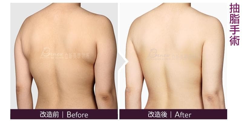 複合式抽脂精雕術,立新美學診所,抽脂對比圖,抽脂,大腿抽脂,瘦大腿,小腿抽脂,手臂抽脂,瘦手臂,腹部抽脂,大腿環抽