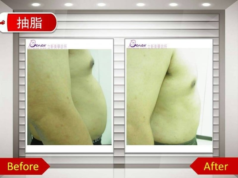 複合式抽脂精雕術,立新美學診所,抽脂對比圖,抽脂,大腿抽脂,瘦大腿,小腿抽脂,手臂抽脂,瘦手臂,腹部抽脂,大腿環抽