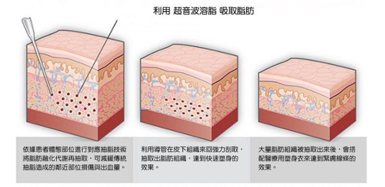 複合式抽脂精雕術,立新美學診所,ULTRA-Z原理圖,利用超音波溶脂吸取脂肪