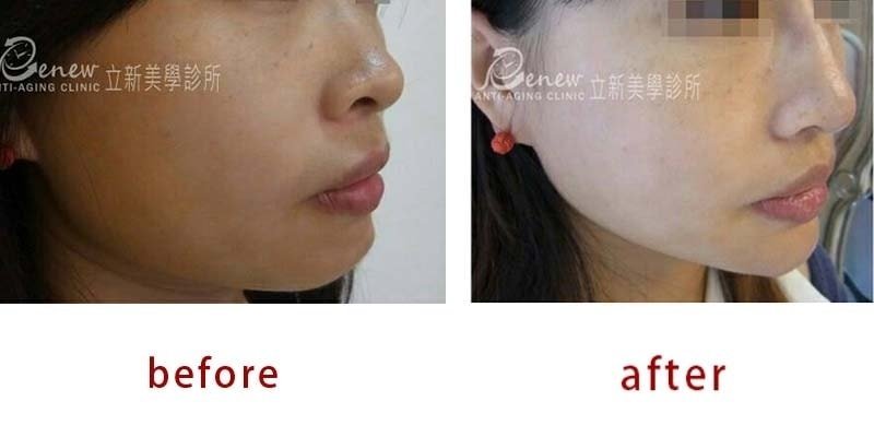 立新美學診所,術前術後對比圖,Quill自體下巴,芭比下巴,整下巴,下巴整形,墊下巴
