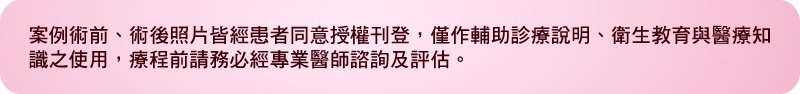 隆乳,自體脂肪隆乳,果凍隆乳,水滴隆乳