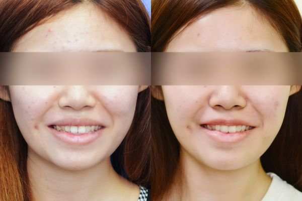 【謝氏縮唇/3D俏唇珠】醜唇形怎麼辦? 謝氏縮唇終結它!,立新美學診所