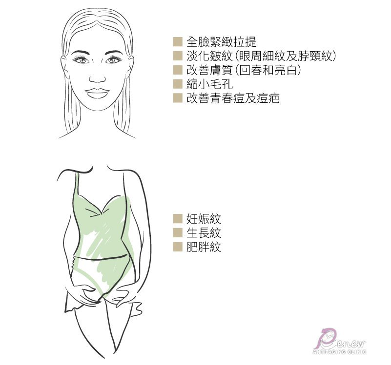 【美魔黃金電波】一機搞定!皺紋、凹洞疤瑕疵膚質、鬆垂肌 通通OUT!,全臉緊緻拉提,淡化皺紋(眼周細紋及脖頸紋),改善膚質(回春和亮白),縮小毛孔,改善青春痘及痘疤,妊娠紋,生長紋,肥胖紋