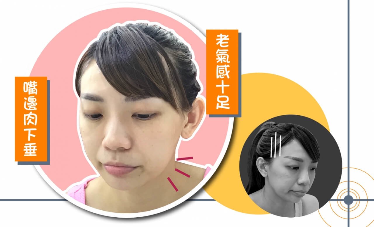 摆脱嘴边肉QUILL 8字让你不显老校园女神败部复活大作战,立新美学诊所,立新诊所,张光正,张光正医师,肉毒,SCU,3D聚左旋乳酸,童颜针,稚龄针,玻尿酸,晶亮瓷,微晶瓷,整形,微整形,手术,拉皮,拉提,QUILL8字拉提,三层次紧颜拉皮,缩唇,微笑唇,双眼皮,