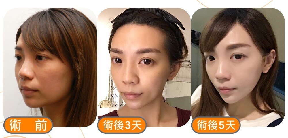 摆脱嘴边肉強升 8字让你不显老校园女神败部复活大作战,立新美学诊所,立新诊所,张光正,张光正医师,肉毒,SCU,3D聚左旋乳酸,童颜针,稚龄针,玻尿酸,晶亮瓷,微晶瓷,整形,微整形,手术,拉皮,拉提,強升8字拉提,三层次紧颜拉皮,缩唇,微笑唇,双眼皮,