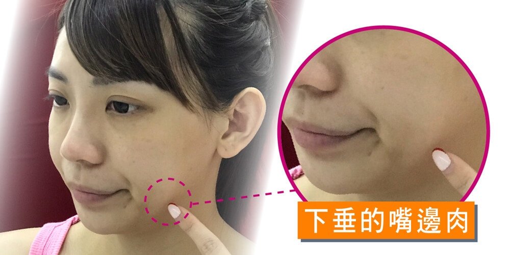 摆脱嘴边肉强升8字让你不显老校园女神败部复活大作战,立新美学诊所,立新诊所,张光正,张光正医师,肉毒,SCU,3D聚左旋乳酸,童颜针,稚龄针,玻尿酸,晶亮瓷,微晶瓷,整形,微整形,手术,拉皮,拉提,QUILL8字拉提,三层次紧颜拉皮,缩唇,微笑唇,双眼皮,