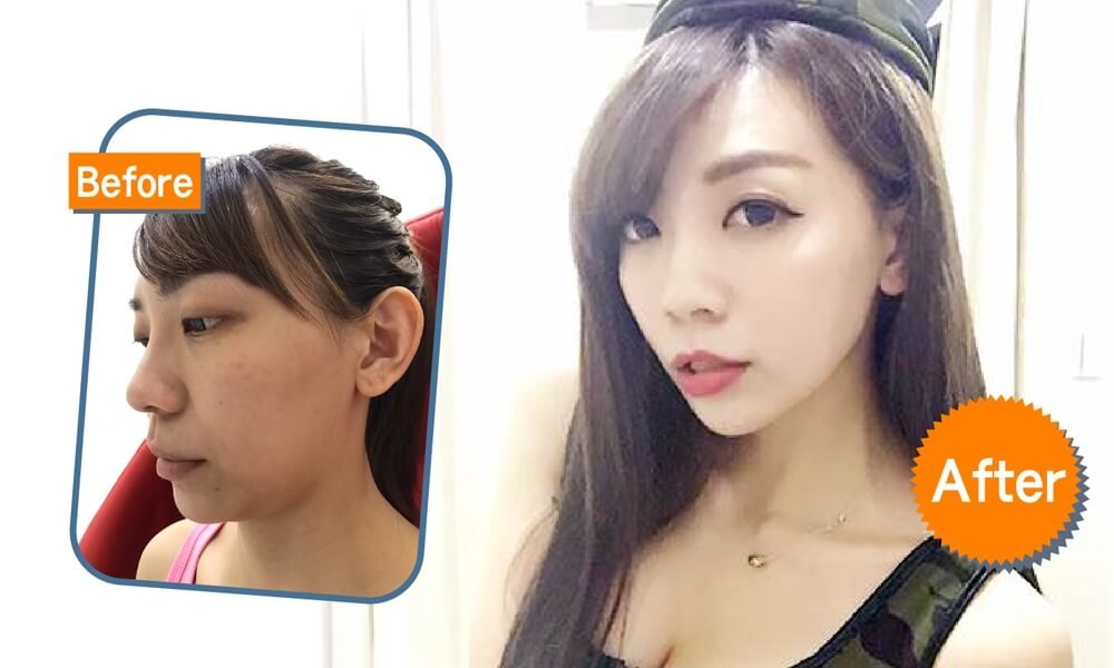 摆脱嘴边肉QUILL 8字让你不显老校园女神败部复活大作战,立新美学诊所,立新诊所,张光正,张光正医师,肉毒,SCU,3D聚左旋乳酸,童颜针,稚龄针,玻尿酸,晶亮瓷,微晶瓷,整形,微整形,手术,拉皮,拉提,QUILL8字拉提,三层次紧颜拉皮,缩唇,微笑唇,双眼皮,