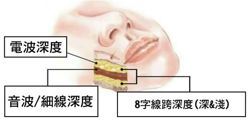擺脫嘴邊肉 QUILL 8字 讓你不顯老 校園女神敗部復活大作戰,立新美學診所,立新診所,張光正,張光正醫師,肉毒,SCU,3D聚左旋乳酸,童顏針,稚齡針,玻尿酸,晶亮瓷,微晶瓷,整形,微整形,手術,拉皮,拉提,QUILL8字拉提,三層次緊顏拉皮,縮唇,微笑唇,雙眼皮,