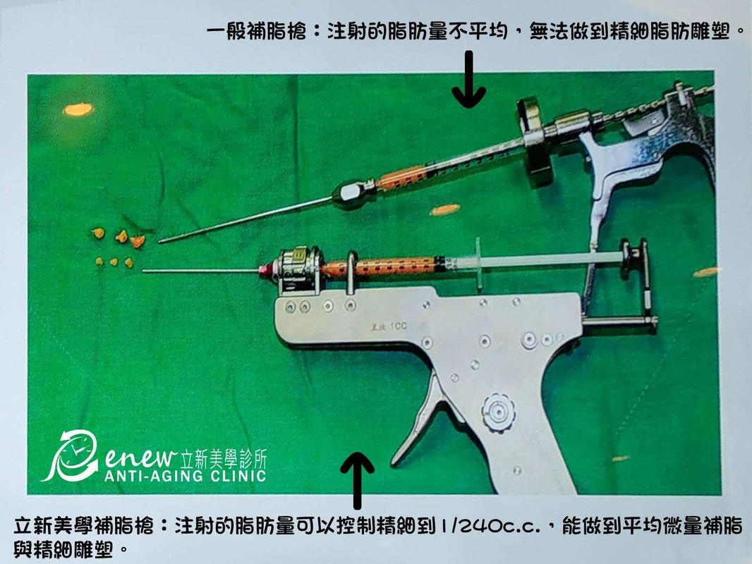【自體脂肪移植補臉】智能型-自體脂肪全臉雕塑,一般補脂槍:注射的脂肪量不平均,無法做到晶矽脂肪雕塑,勵馨美學補脂槍:注射的脂肪量可以控制精細到1/240c.c,能做到平均微量補脂與精細雕塑。