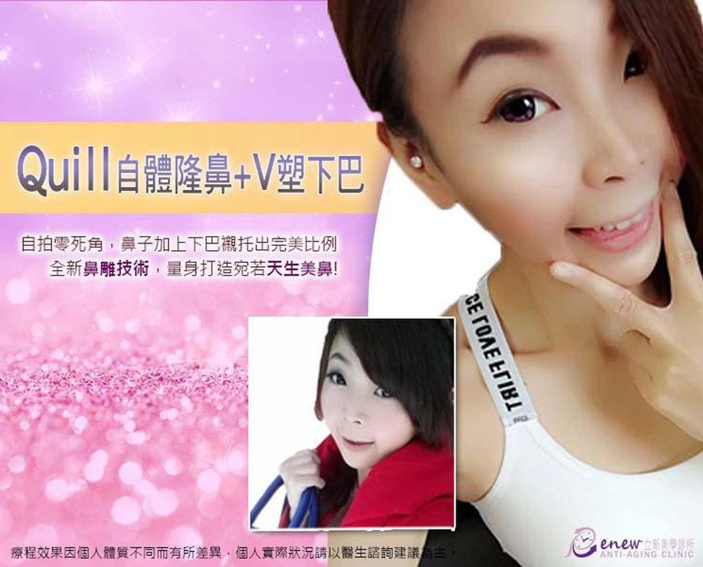 【全真自體系列-QUILL自體隆鼻(Q鼻)+安全可吸收材質撐架】五官立體高顏值 決勝點靠高挺鼻+小巧尖下巴
