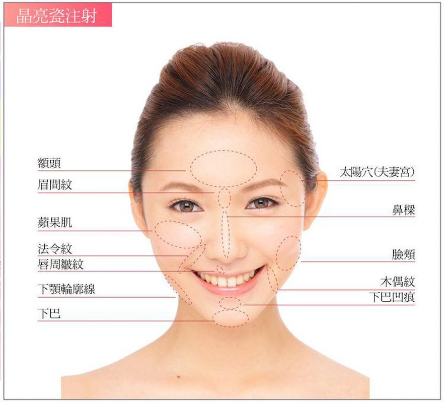 【全真自體系列-QUILL自體隆鼻(Q鼻)+安全可吸收材質撐架】五官立體高顏值 決勝點靠高挺鼻+小巧尖下巴
