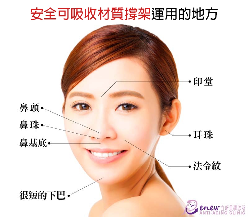 【全真自體系列-QUILL自體隆鼻(Q鼻)+安全可吸收材質撐架】五官立體高顏值 決勝點靠高挺鼻+小巧尖下巴