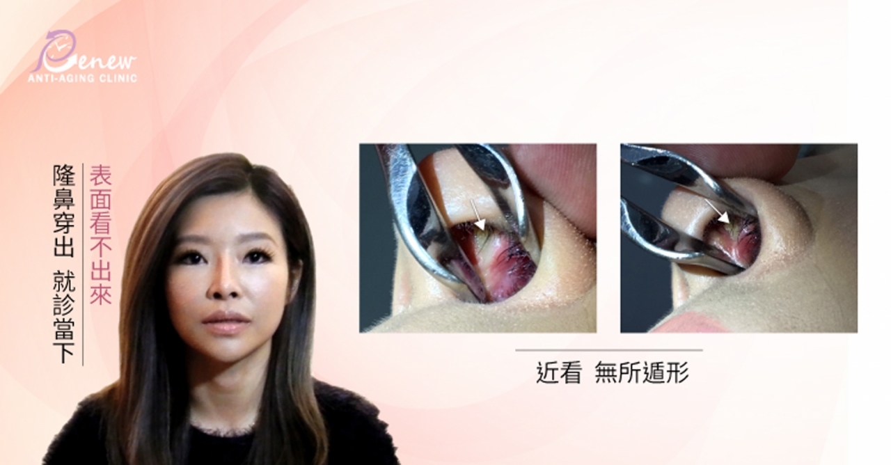 【全真自體系列-QUILL自體隆鼻(Q鼻)+安全可吸收材質撐架】五官立體高顏值 決勝點靠高挺鼻+小巧尖下巴